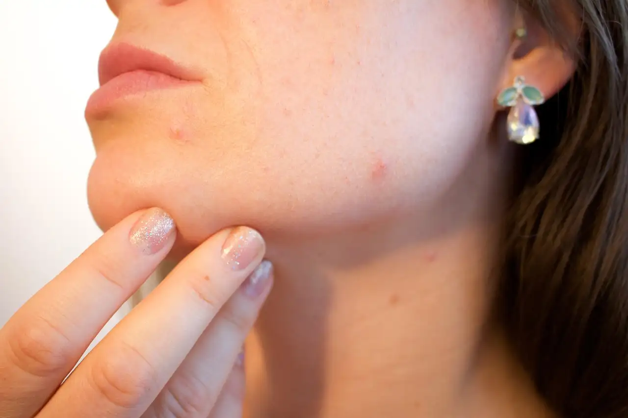 Voeding en acne